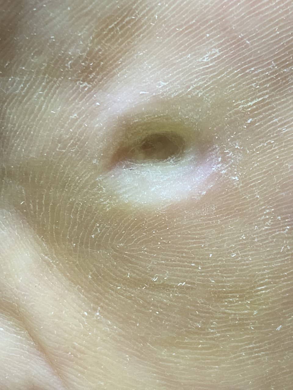 Натоптыши После обработки