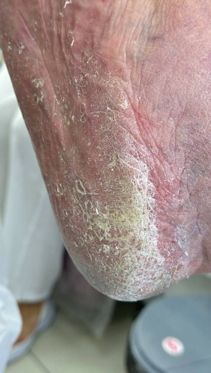 трещины ногтей