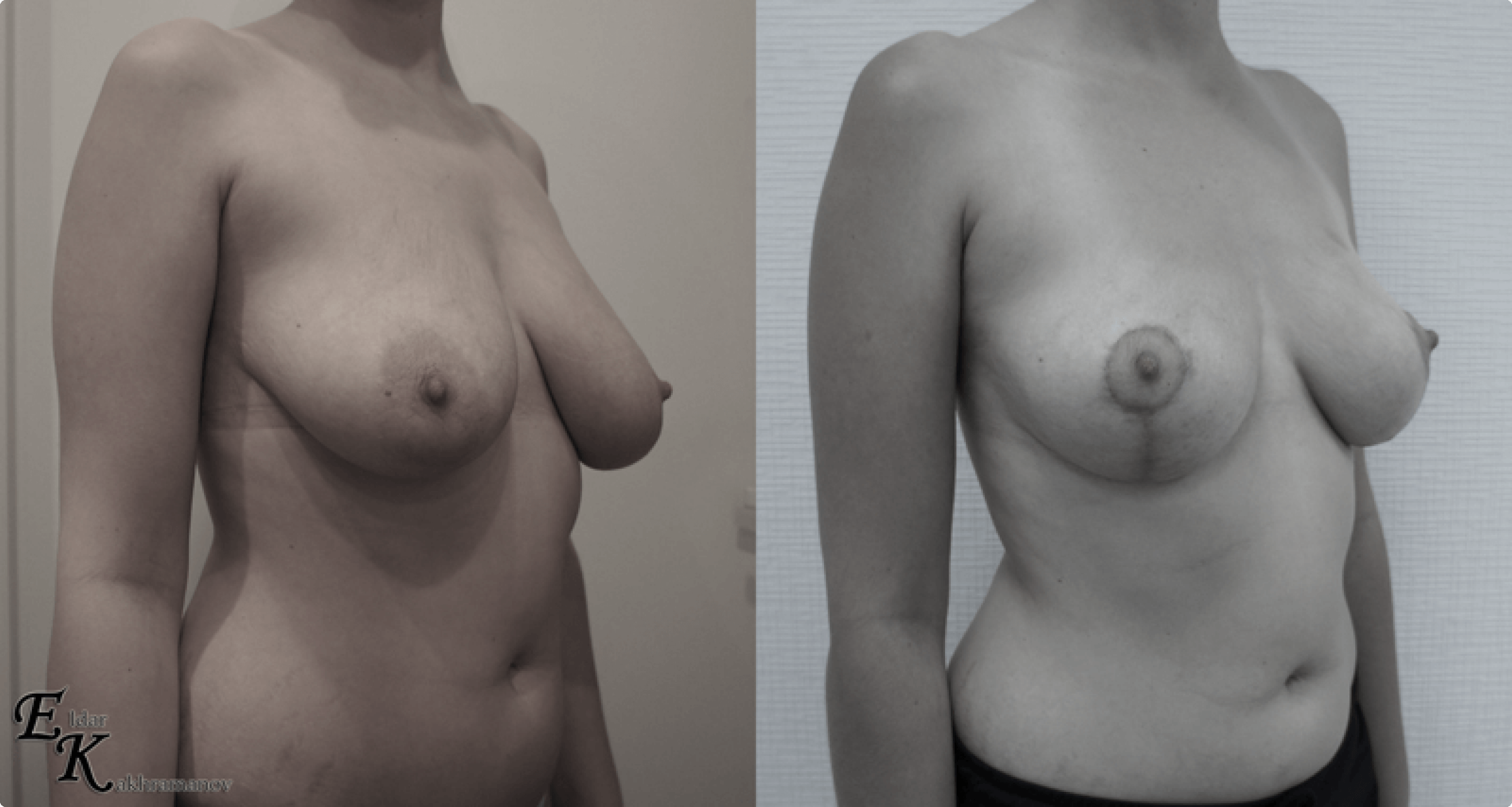 операция по подтяжке груди у женщин фото 24