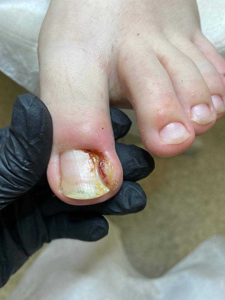 Вросший ноготь