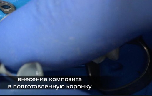 Фиксация