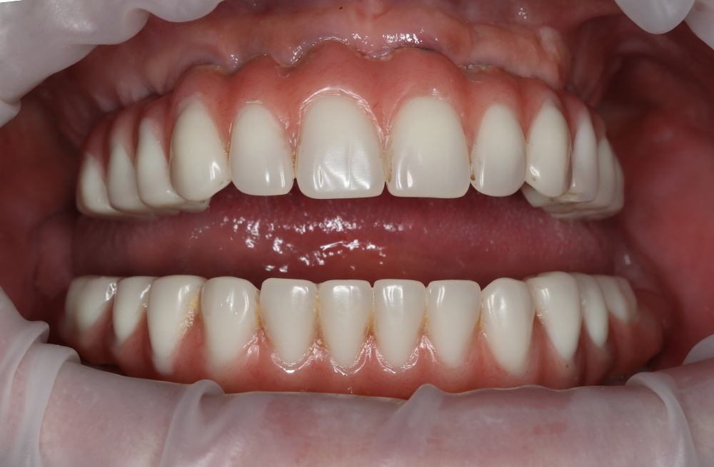 Комплексная гигиена полости рта у пациента с несъёмными конструкциями