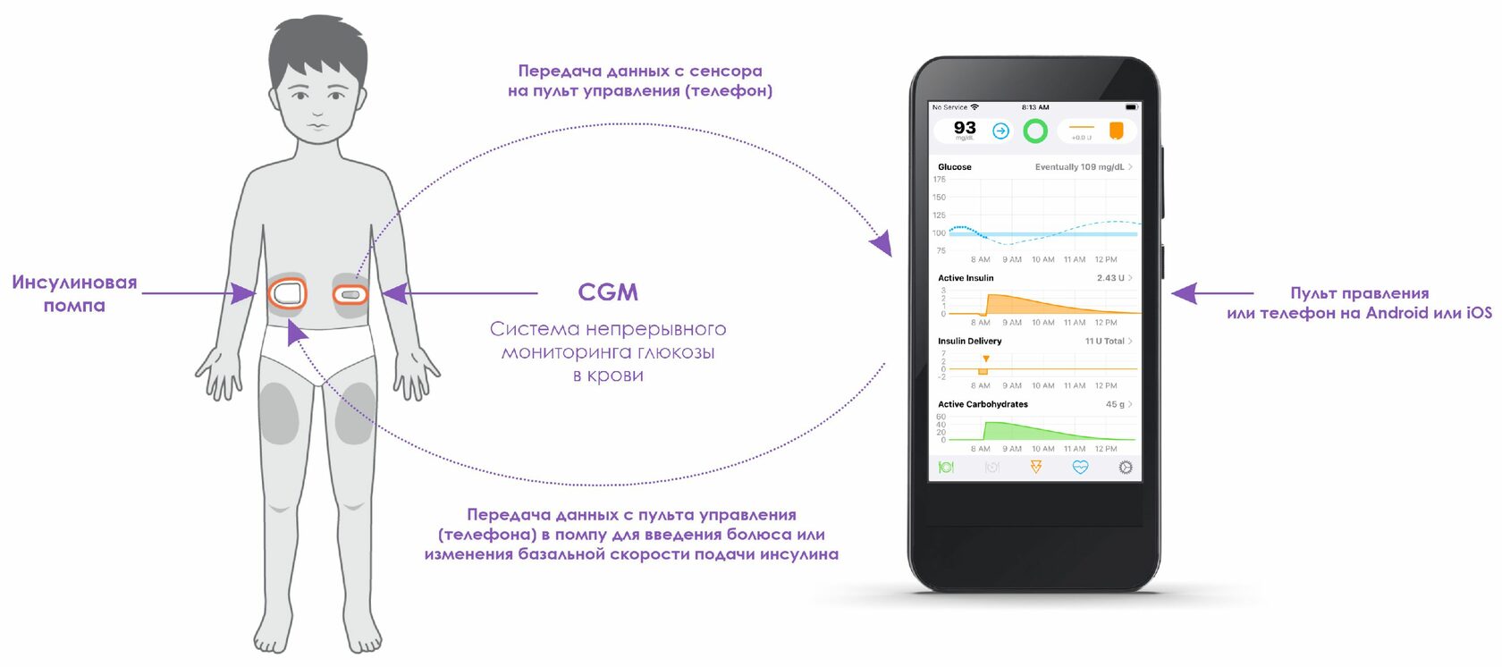 Замкнутая петля для инсулиновой помпы