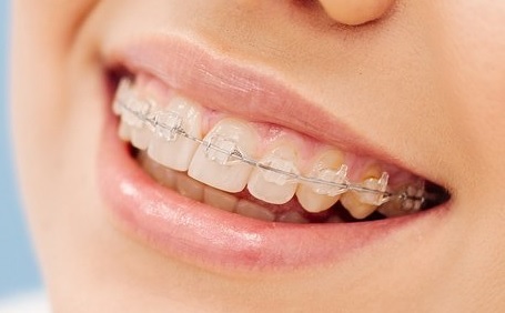 breketi sapfirovie Влияние ортодонтического лечения на качество жизни пациента: от эстетики до функциональности