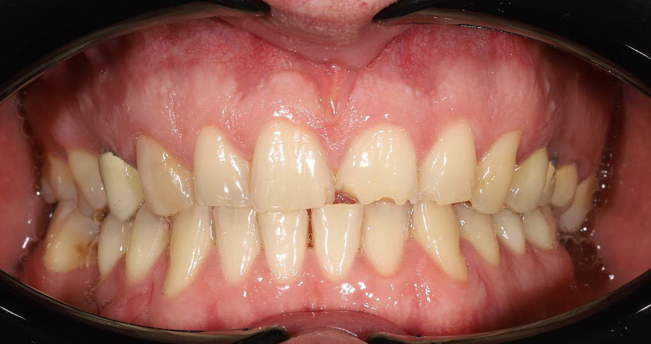 Лечение металлическими брекетами Damon Q2