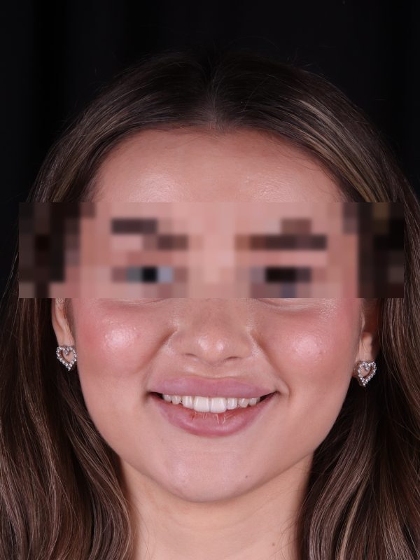 Исправление прикуса — фото до лечения, Elite Denta