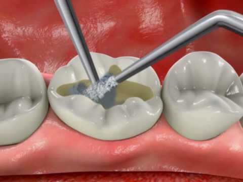 Стоимость удаление нерва зуба