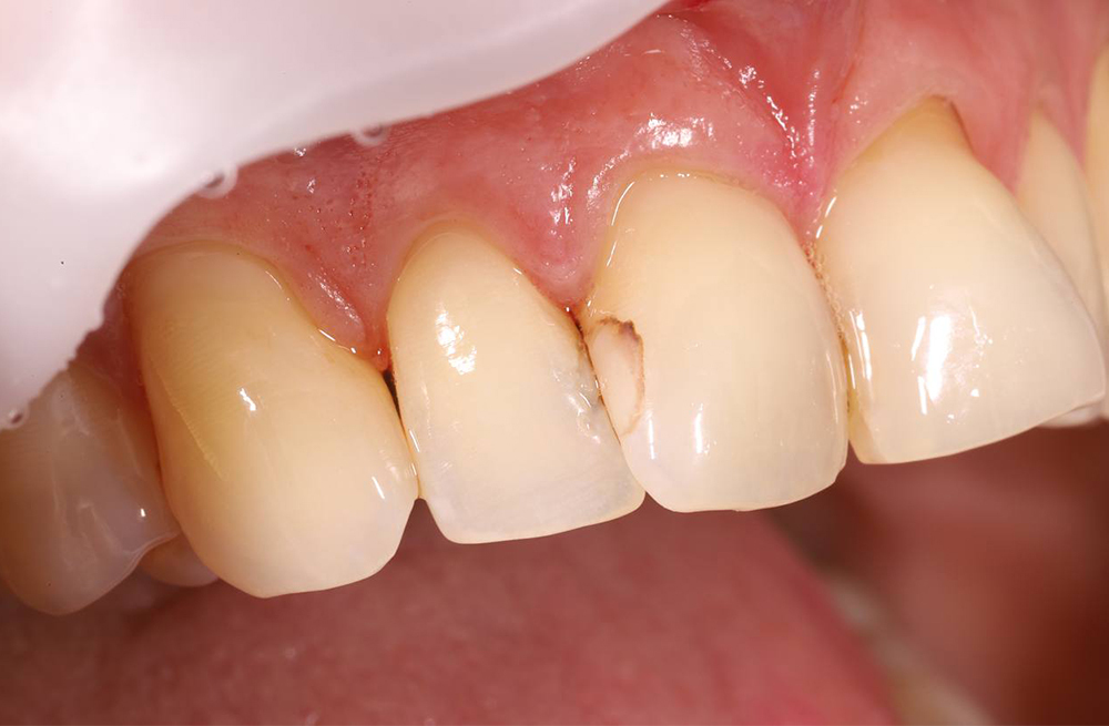 Эстетическая реставрация переднего зуба для устранения видимого дефекта