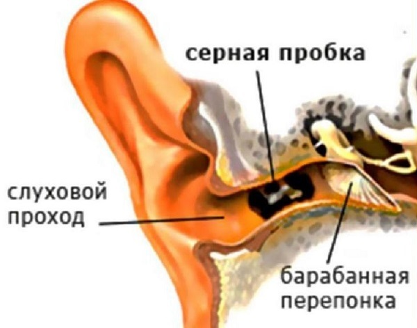 Серные пробки – симптомы, причины, как удалять - МедКом