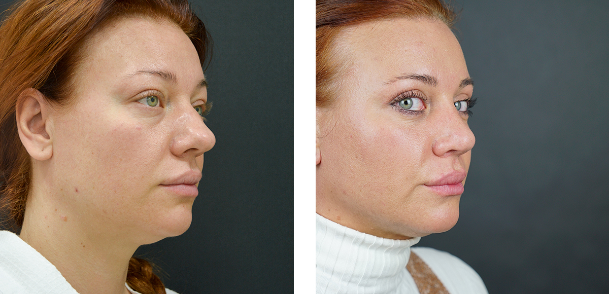 Ринопластику блефаропластику. Неудачная ринопластика. Периорбитопластика рыбакин. Блефаропластика в махачкале. Блефаропластика носа до и после.