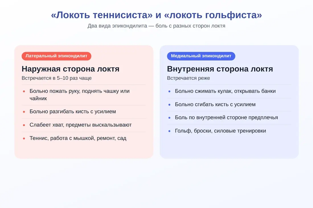 Латеральный и медиальный эпикондилит: локоть теннисиста и локоть гольфиста