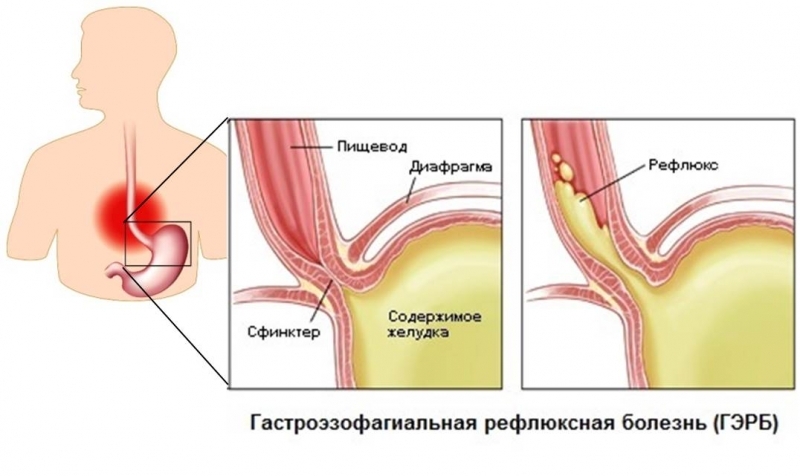 Грыжа грудного отдела позвоночника - симптомы и лечение