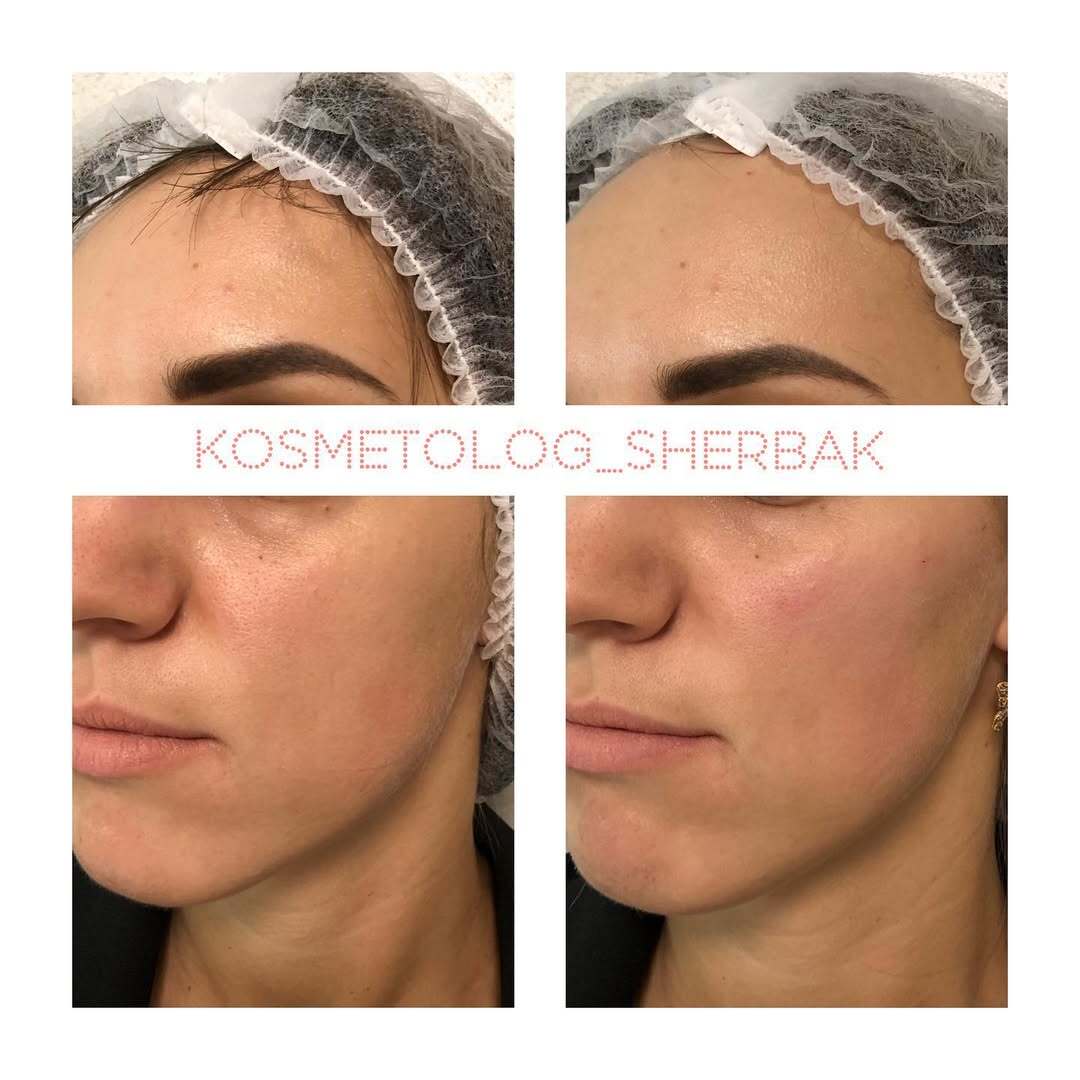 Контурная пластика лица в клинике PradusCOSMO, Санкт-Петербург. Естественный результат без эффекта переделанного лица