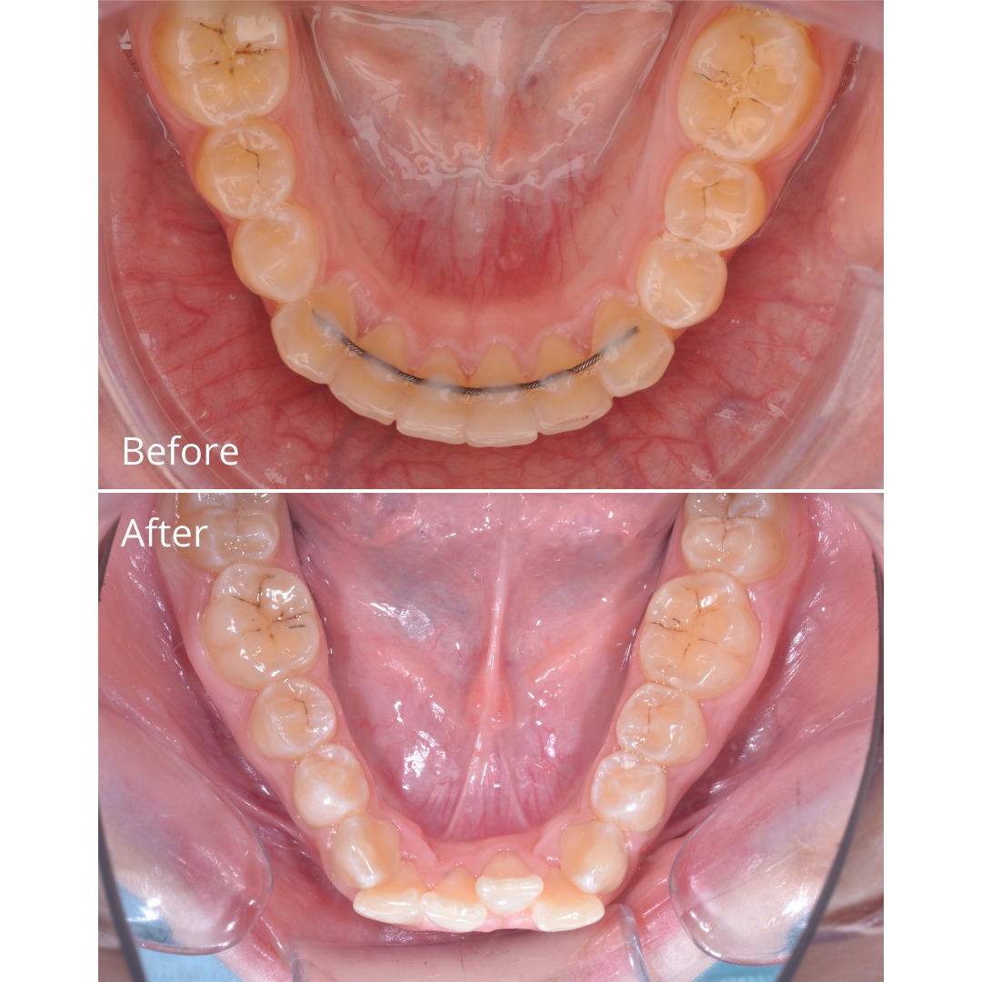 After photo showing a harmonious, well-aligned result after two-phase treatment — photo 6 of 6