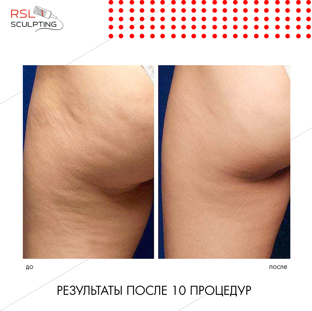 Целлюлит на бедре до и после 10 процедур РСЛ-скульптурирования