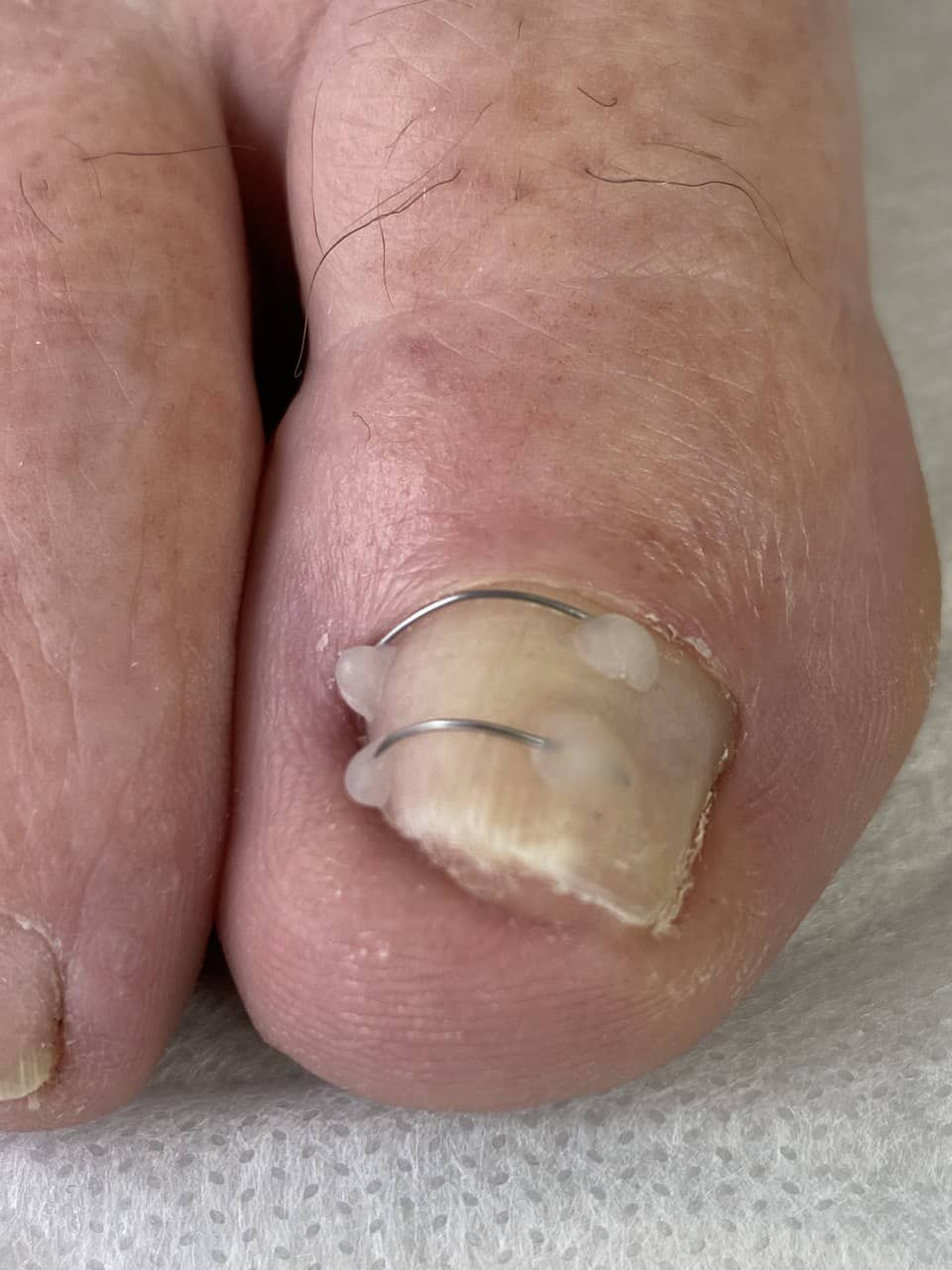 корректирующая система +для ногтей