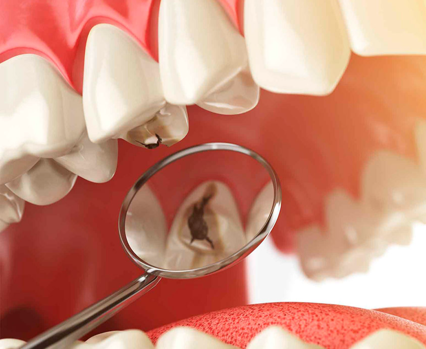 Эффективное лечение зубов
