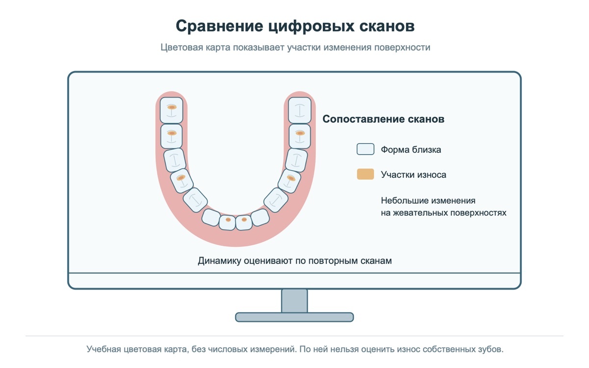 Сравнение цифровых сканов зубного ряда при наблюдении за износом