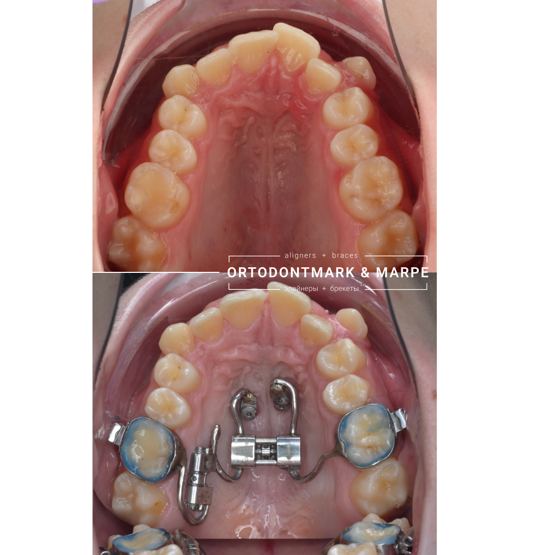 MARPE case result 16