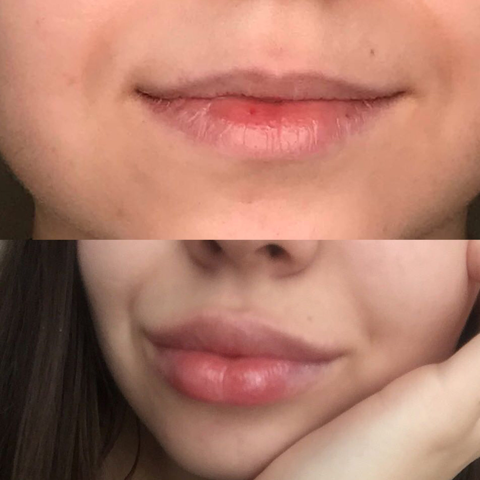 Парижская техника увеличения губ фото до и после