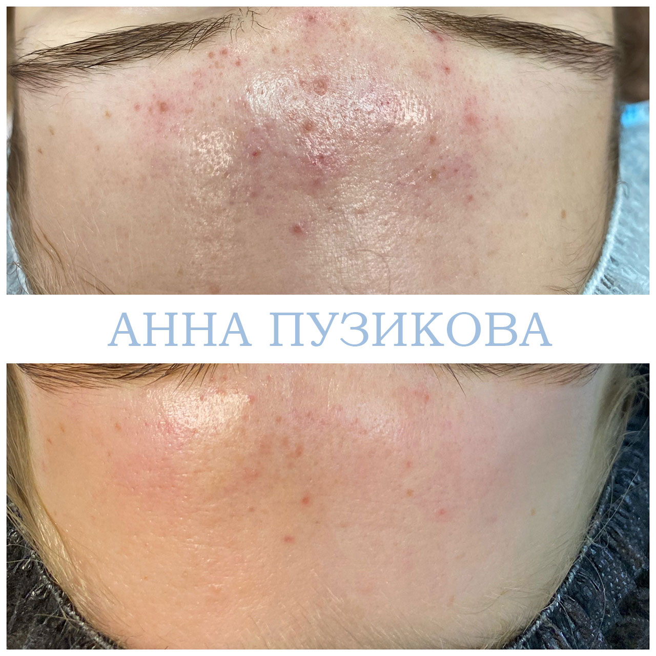 Результат лечения акне и воспалений кожи после курса процедур у косметолога Анны Пузиковой в клинике Прадус (СПб).