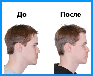 Установка имплантов в Дербенте. Имплантация при отсутствии одного зуба.