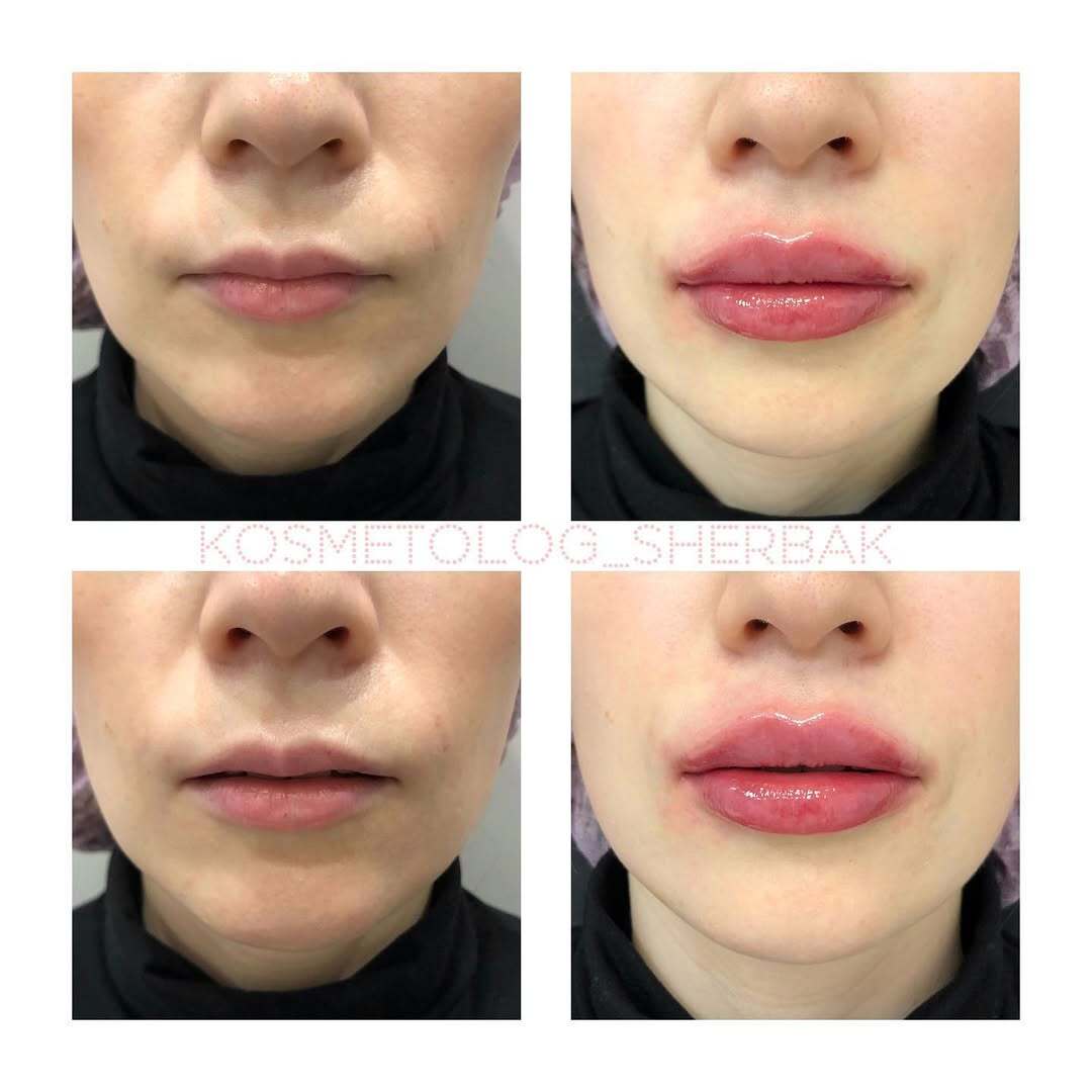 До и после контурной пластики губ. Увеличение объёма без утяжеления. PradusCOSMO, Васильевский остров