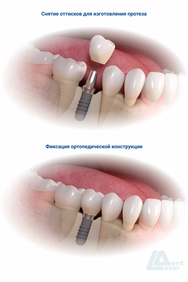 Имплантация зубов в стоматологии Лазердент Хабаровск