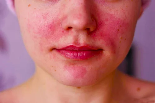 Аллергия на косметику: 9 опасных аллергенов, которые следует избегать