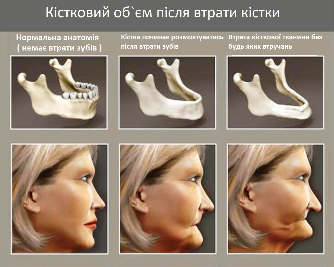 Імплантація зубів Львів, протезування зубів — Клініка Онутчака