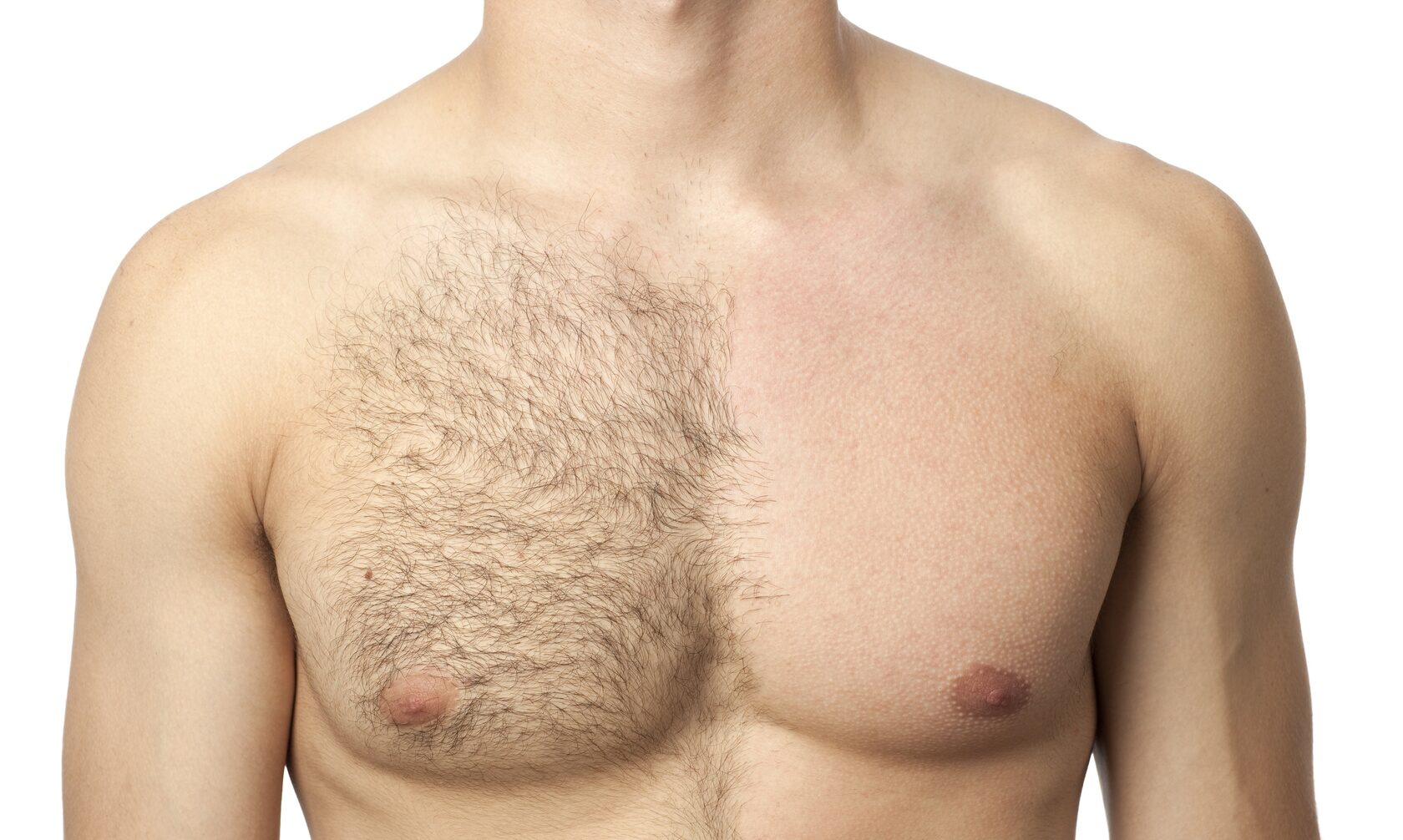 депиляция волос на груди у мужчин (120) фото