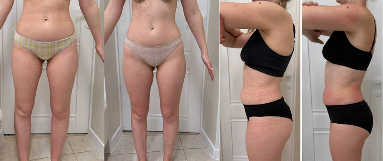 Эффект ДО и ПОСЛЕ процедуры 