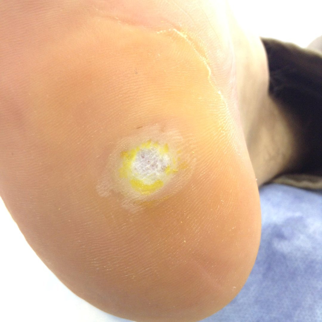 Устранение подошвенных бородавок в Курске