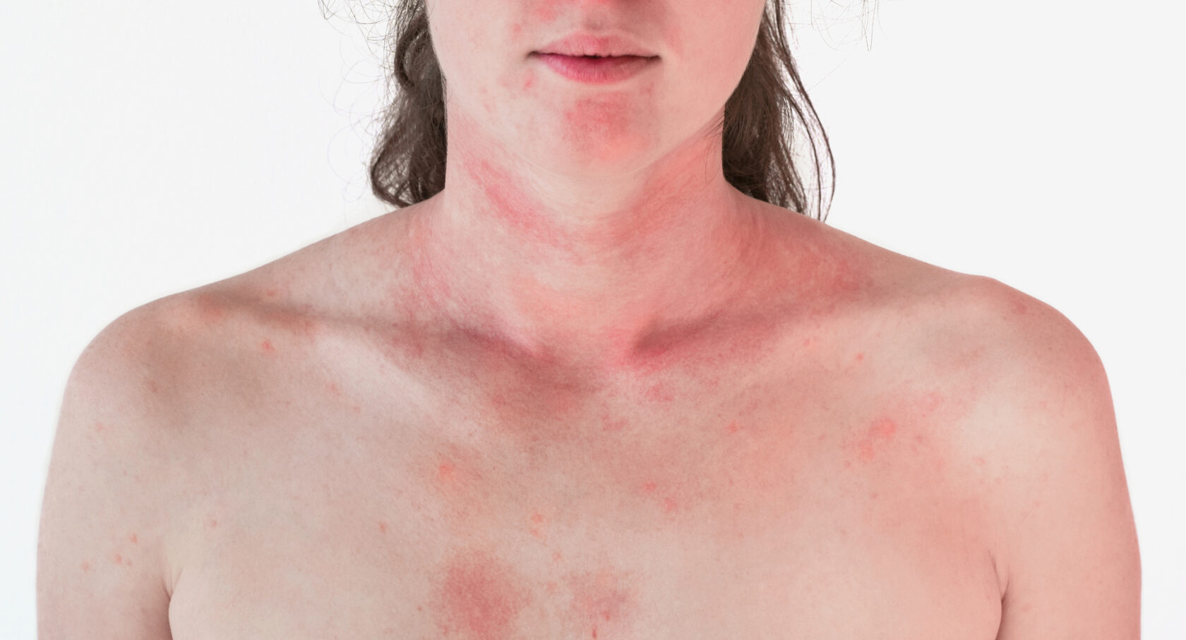 покраснение кожи на груди у женщин фото 80