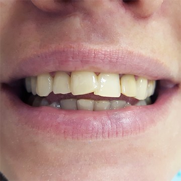 Какие бывают кривые зубы?