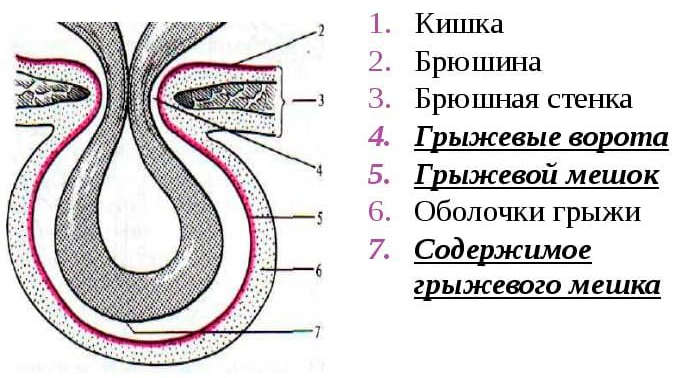 Внутренние органы могут составлять часть стенки грыжевого мешка при следующих грыжах тест