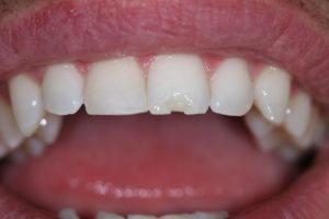 Что делать, если случился скол зуба?