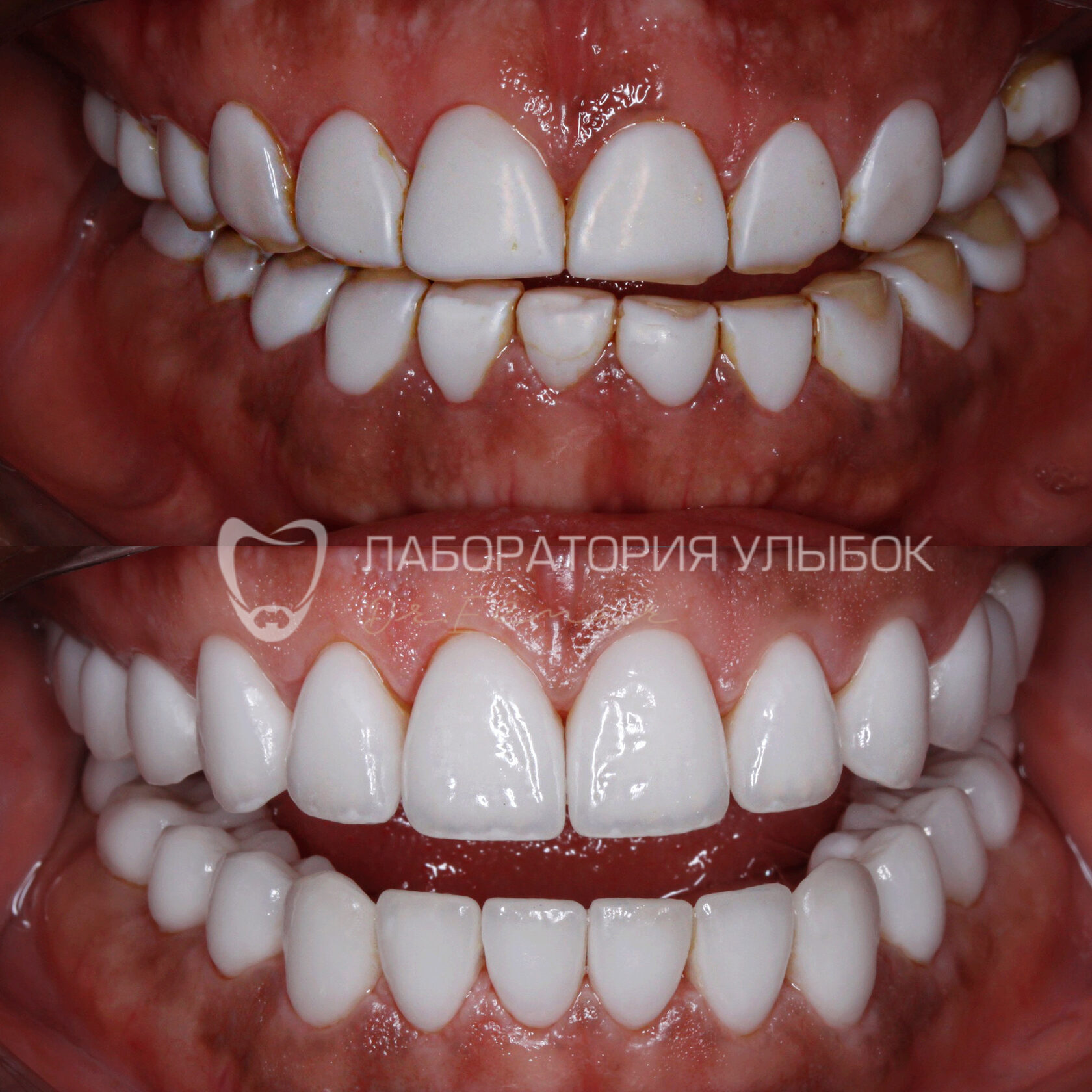 Виниры в стоматологии Доктора Эльмара