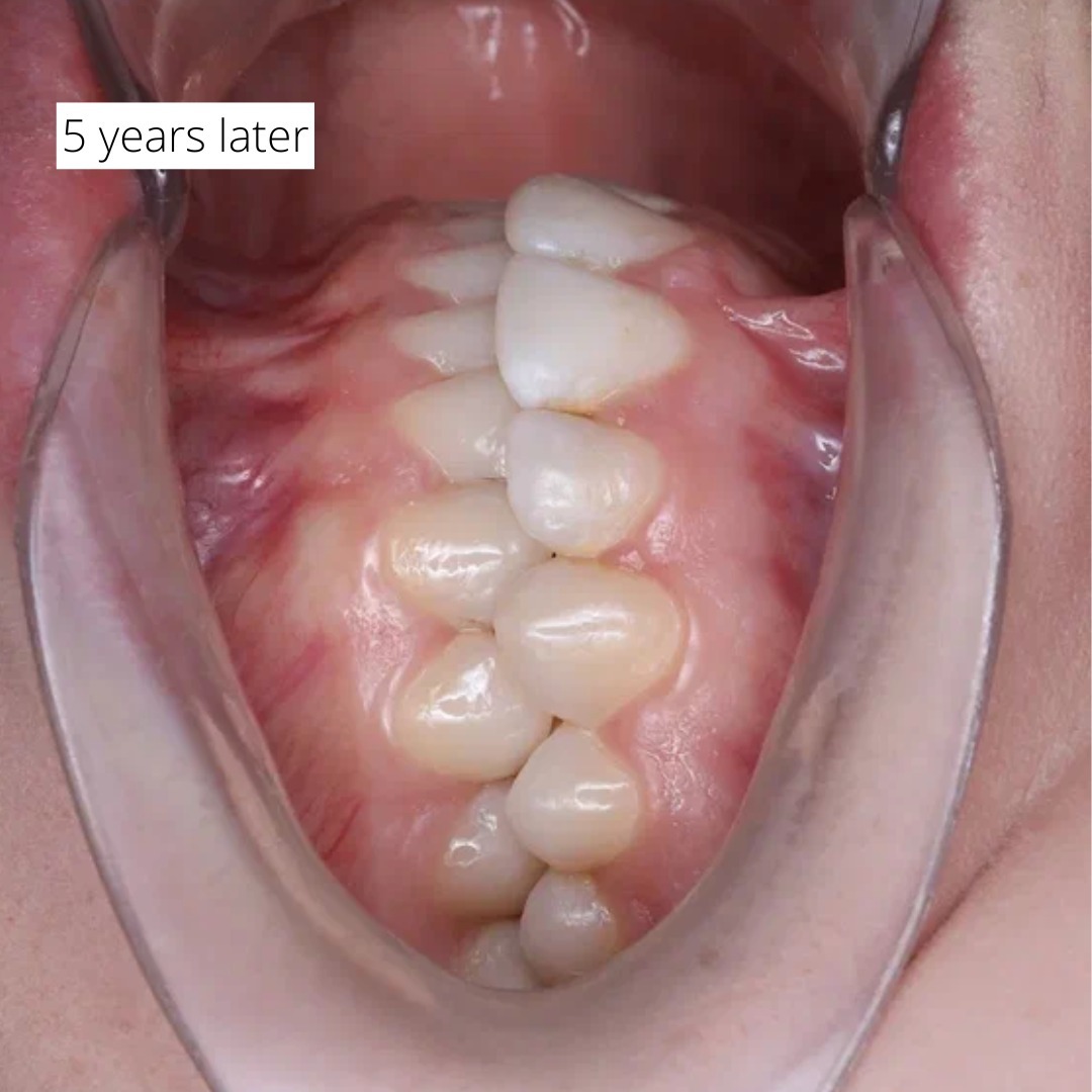Five-year follow-up view showing a stable, functional, and esthetic result — photo 6 of 6
