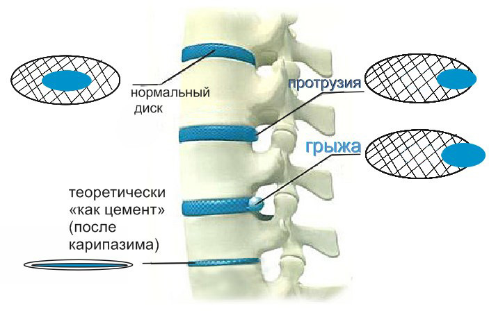 Карипазимовый метод