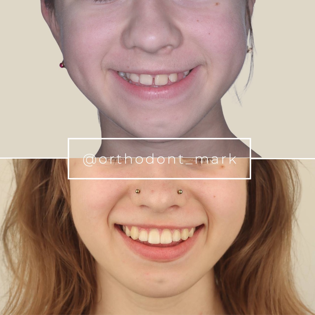 Before treatment view showing maxillary constriction prior to MARPE expansion protocol