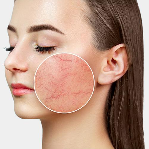 Элос удаление сосудов