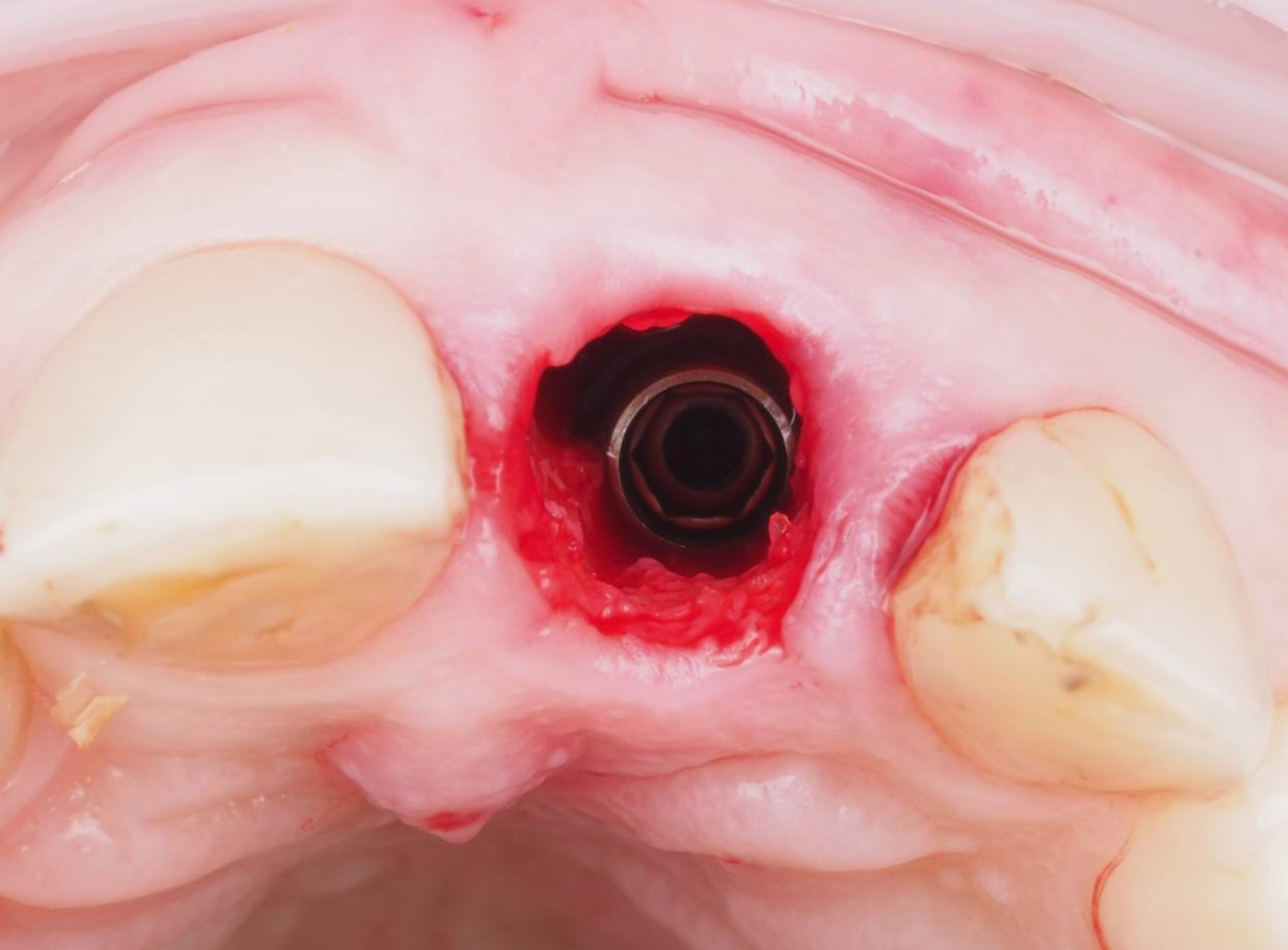 установка имплантата Эниридж