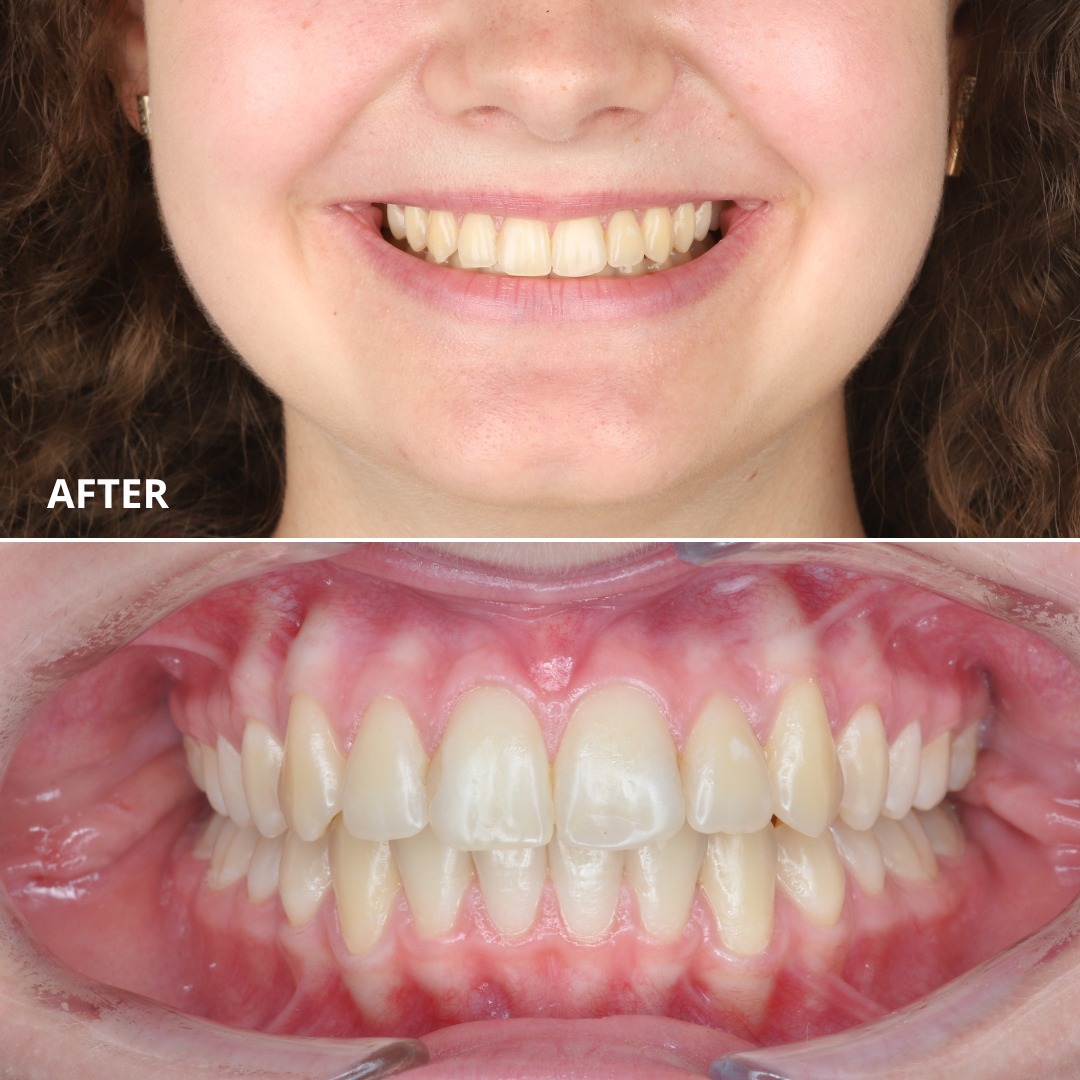 Final result showing a harmonious, stable smile after comprehensive treatment — photo 6 of 6