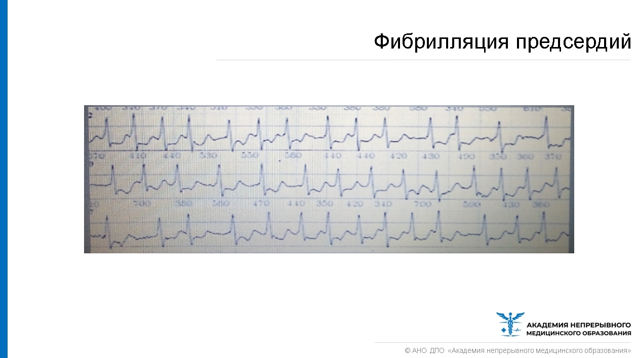 Пароксизм фибрилляции предсердий карта вызова скорой медицинской помощи