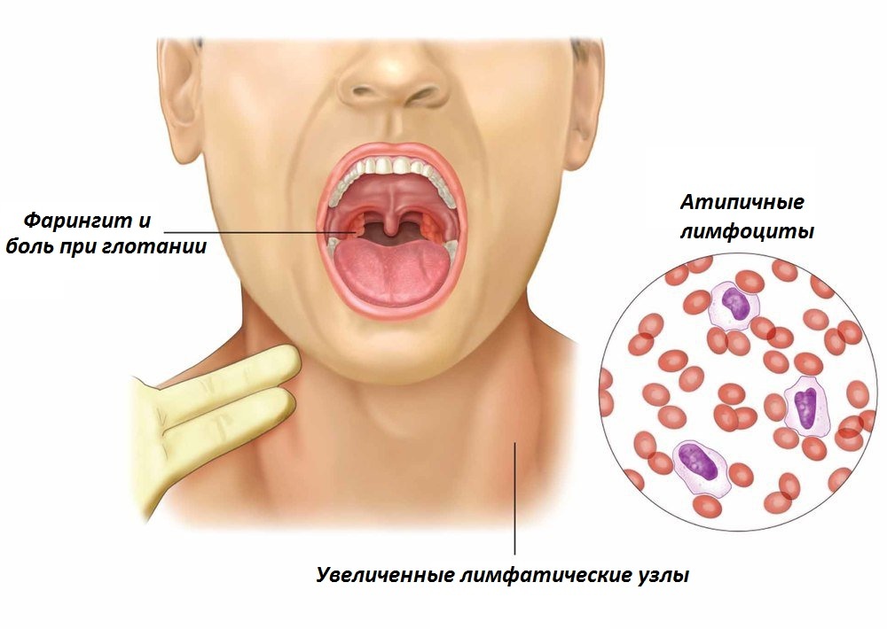 Боль в горле: причины и эффективное лечение | Клиника Рассвет