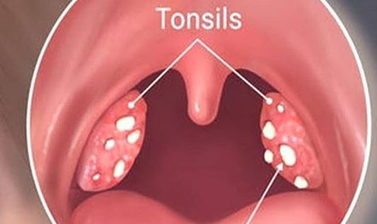 тонзиллит пробки в горле