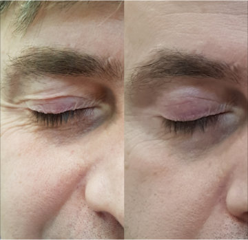 Купить аппарат холодной плазмы для косметологии и личного использования.