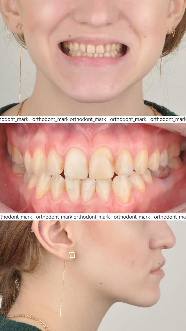 Facial and Smile Transformation with Orthognathic Surgery