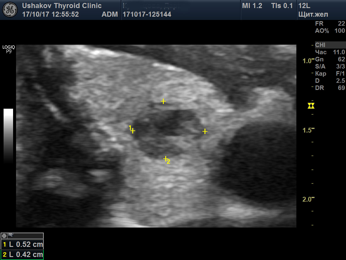 Сегменты щитовидной железы на узи схема
